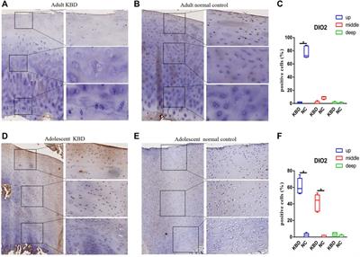 Detection of selenoprotein transcriptome in chondrocytes of patients with Kashin–Beck disease